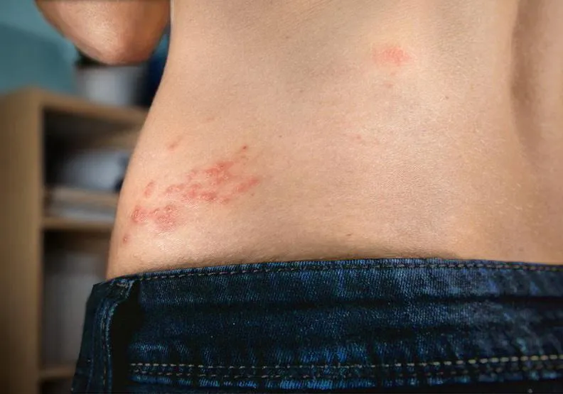 氣溫忽冷忽熱「皮蛇」伺機爆發　中西醫整合提升免疫力