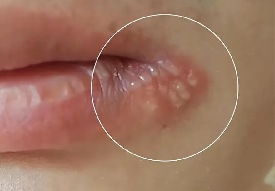 別以為只是火氣大！陸女嘴角長水泡未重視　送醫當晚宣告腦死