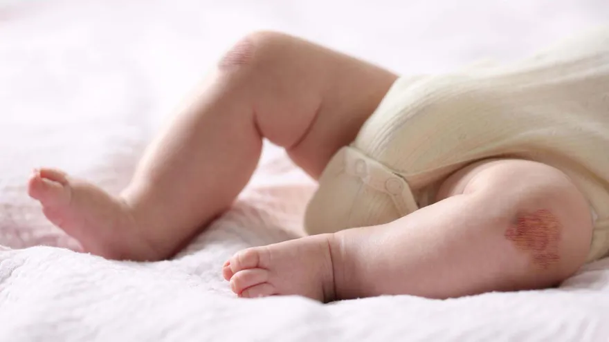 孩子輕碰就瘀青？3歲童摔倒「膝蓋腫如橘子」確診血友病