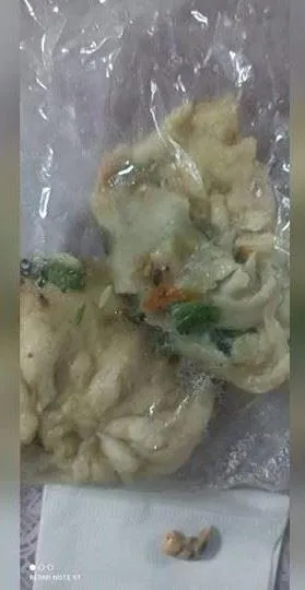 台東水煎包內驚見假牙一枚！　牙醫證實了：有牙周病