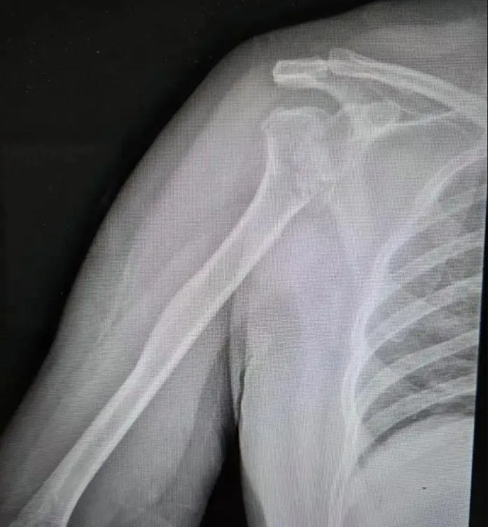 她夢中驚醒「右臂粉碎性骨折」　陸醫揭「神秘暴力」竟是癲癇