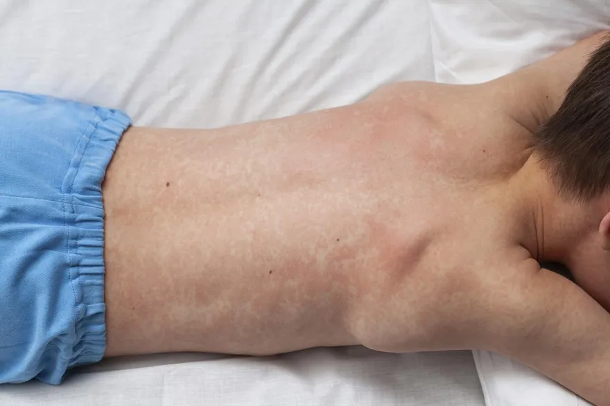 日本麻疹疫情燒到台灣？醫籲3類人速補打疫苗