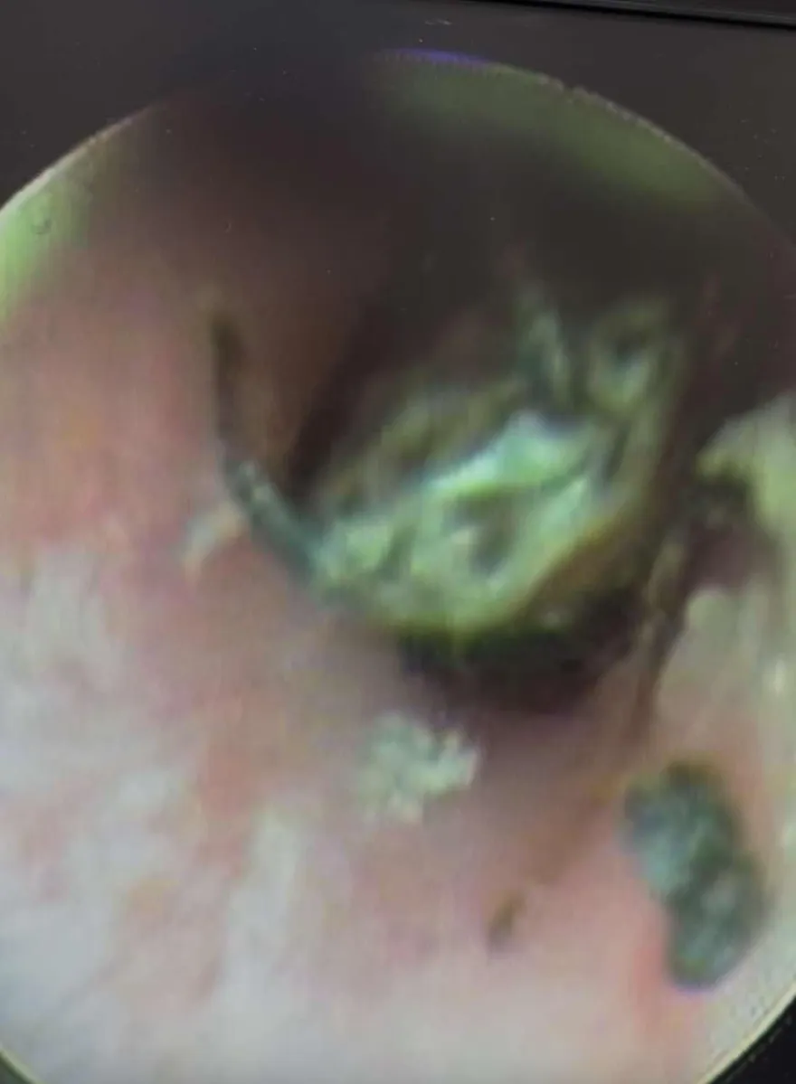 有影片！少女耳朵劇痛「活蟑螂掙扎竄逃」　醫一夾診間迴盪尖叫聲