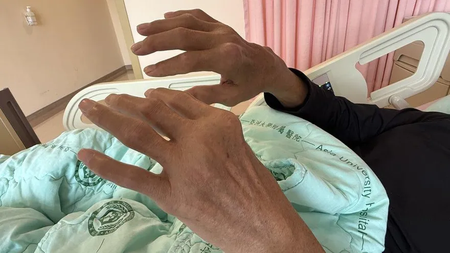 男子痛風石如雞蛋大破裂　醫：嚴重恐截肢