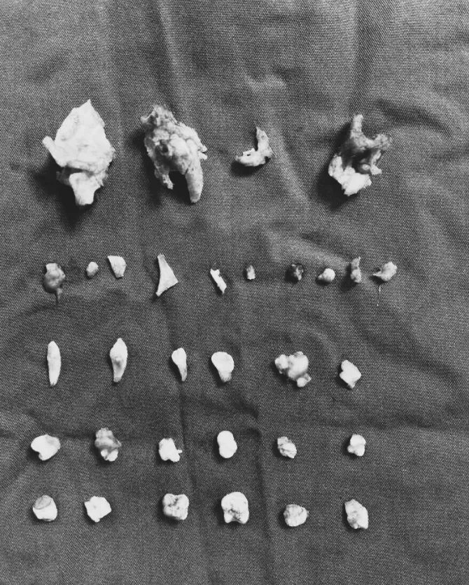 陸少女腹部突劇痛　就醫才知長12cm腫瘤「內藏24顆牙齒」