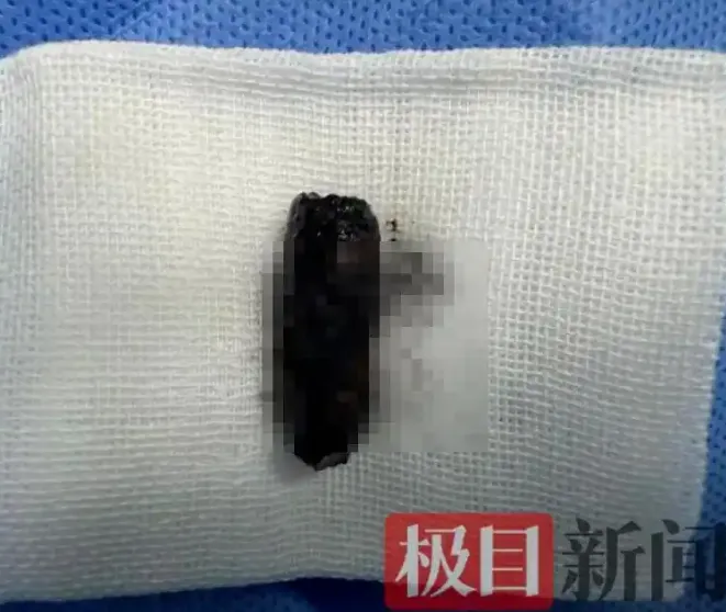 陸男鼻子狂流膿飄異味　檢查驚揭「3公分螺絲藏鼻腔」40年