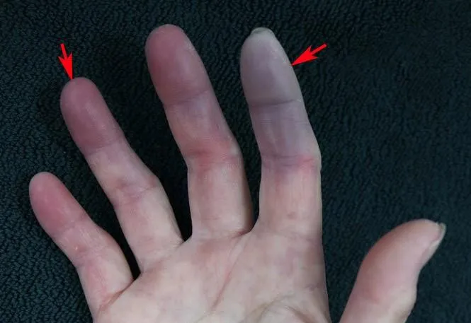 手指變紫以為末梢循環差！看診無效竟是罕見「硬皮症」