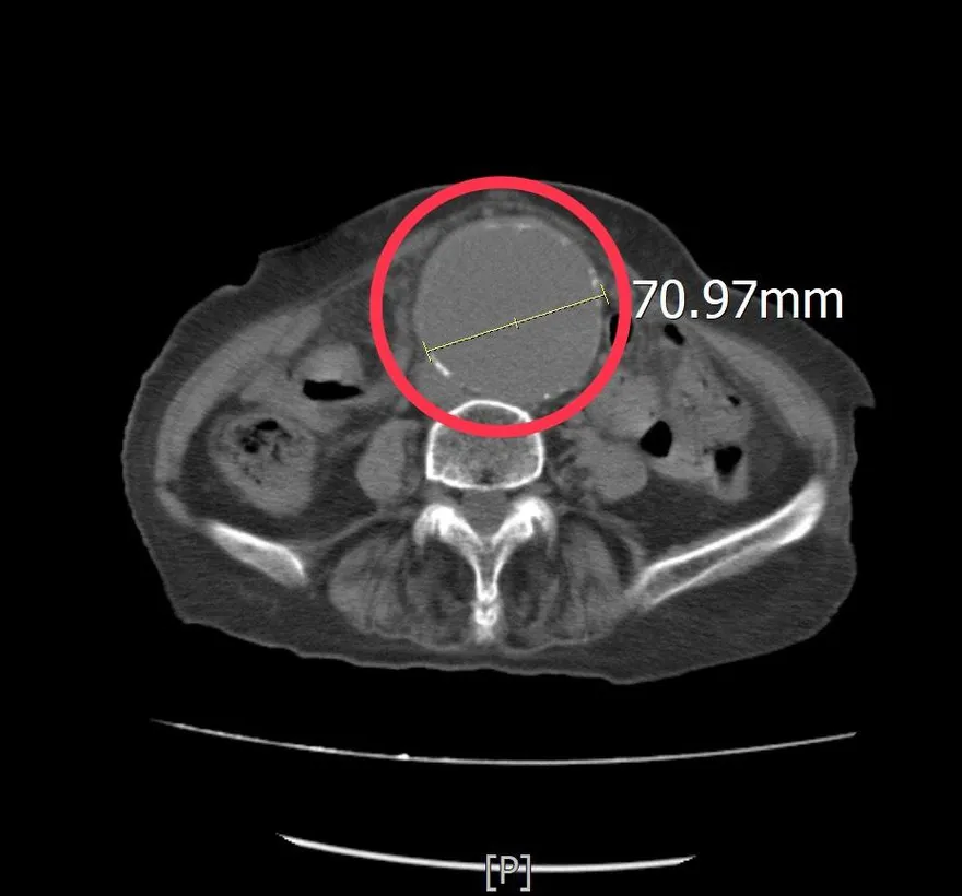 腳痠一週以為肌肉疲勞！8旬婦急診查出7公分腹主動脈瘤