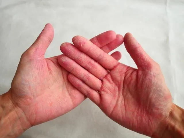 不只手抖！帕金森氏症早期前兆多　睡眠異常、便秘要當心