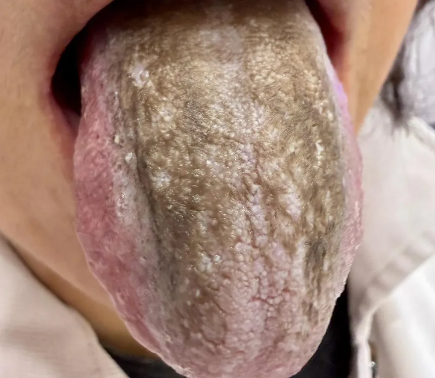 狂漱口6次想殺菌！牙周病女驚見「黑毛舌」 醫揭恐怖成因