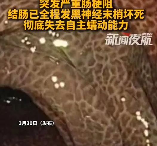 嚇！陸女狂喝通便茶10年赫見「豹紋腸」　發黑壞死切30cm