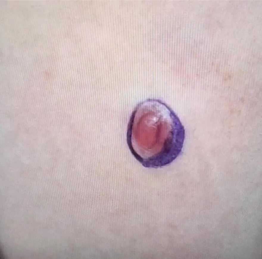 14歲弟肚皮長痘痘狂摳　醫生一切片嚇傻：竟然是這癌！