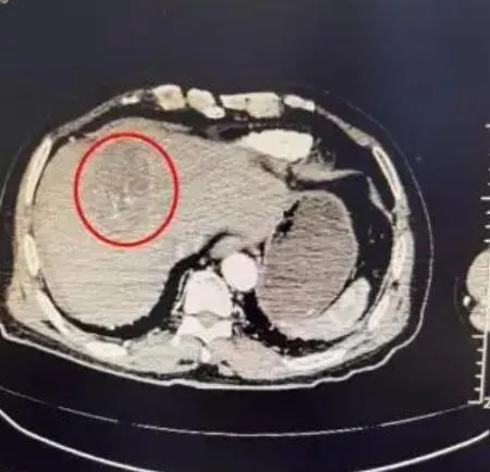 跳個舞差點沒命！陸七旬嬤跳廣場舞過猛「腫瘤破裂」急開刀