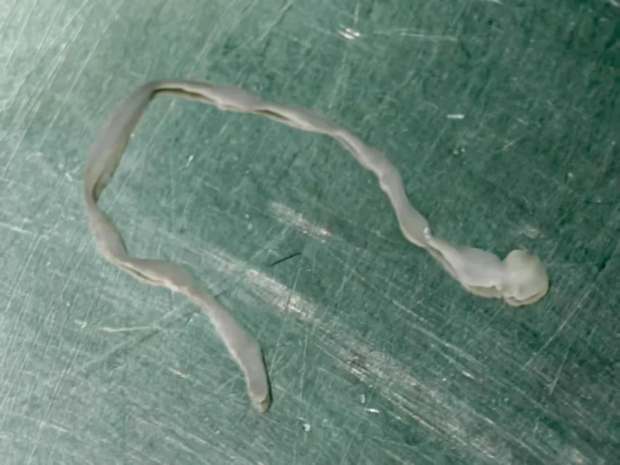 驚！陸6旬婦腦中取出「8cm活蟲」　疑用「生蛙腿」治牙痛惹禍