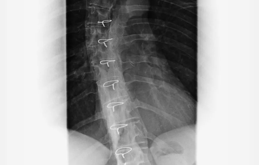 腰痛別只怪老化！醫搖頭：久坐才是椎間盤退化的真正元凶