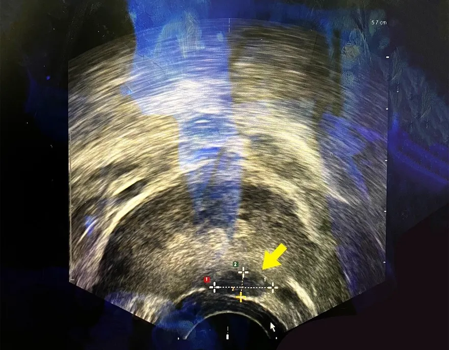 6旬男怕術後失性功能！選「海神刀」消融攝護腺癌零傷口