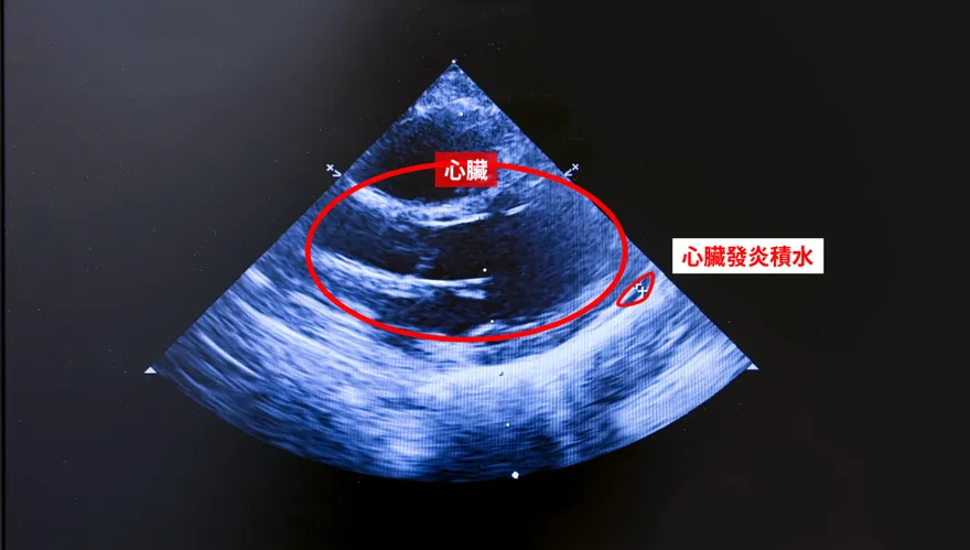 1歲童反覆高燒眼紅嘴腫　確診川崎氏症險釀心臟併發症