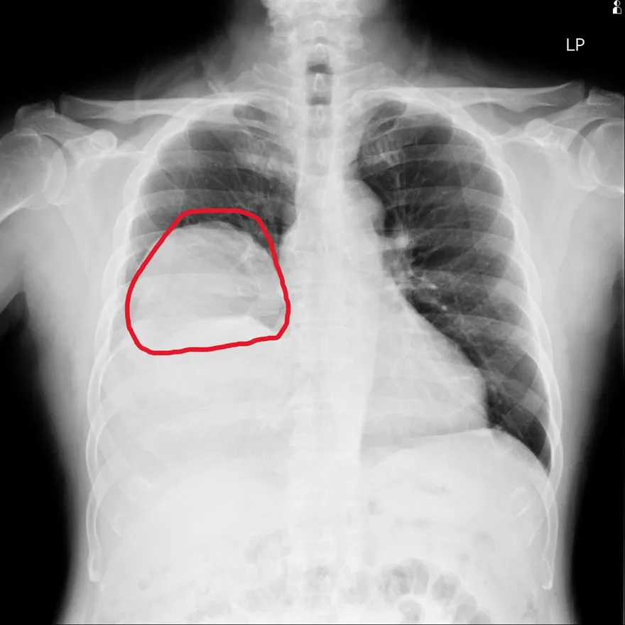 反覆昏迷血糖僅30！7旬翁肺裡藏顆「25公分大腫瘤」