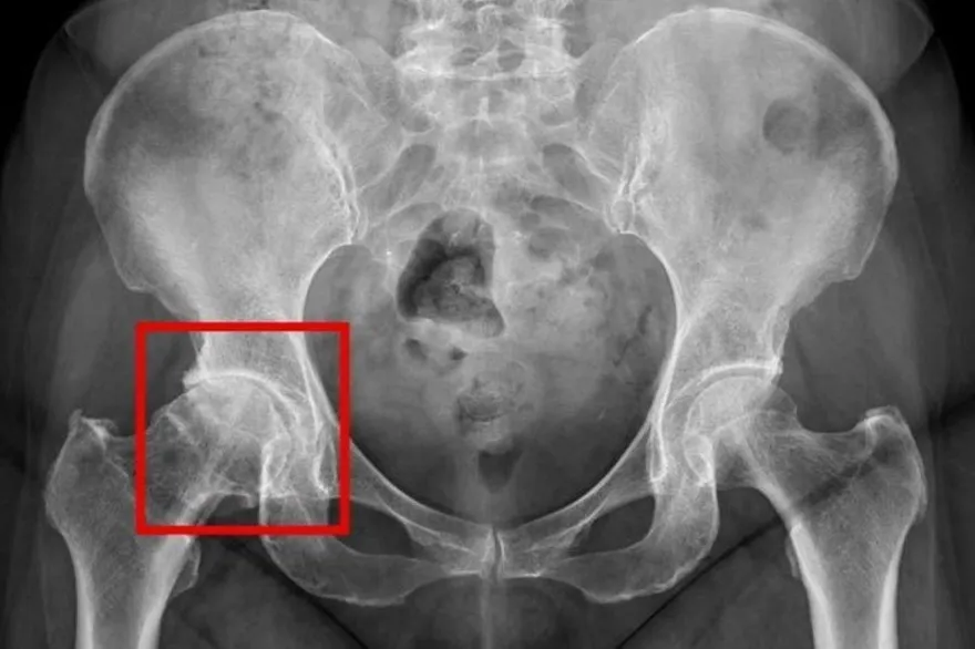 翁下背痛吃藥好不了！醫揭「髖關節退化」才是元兇