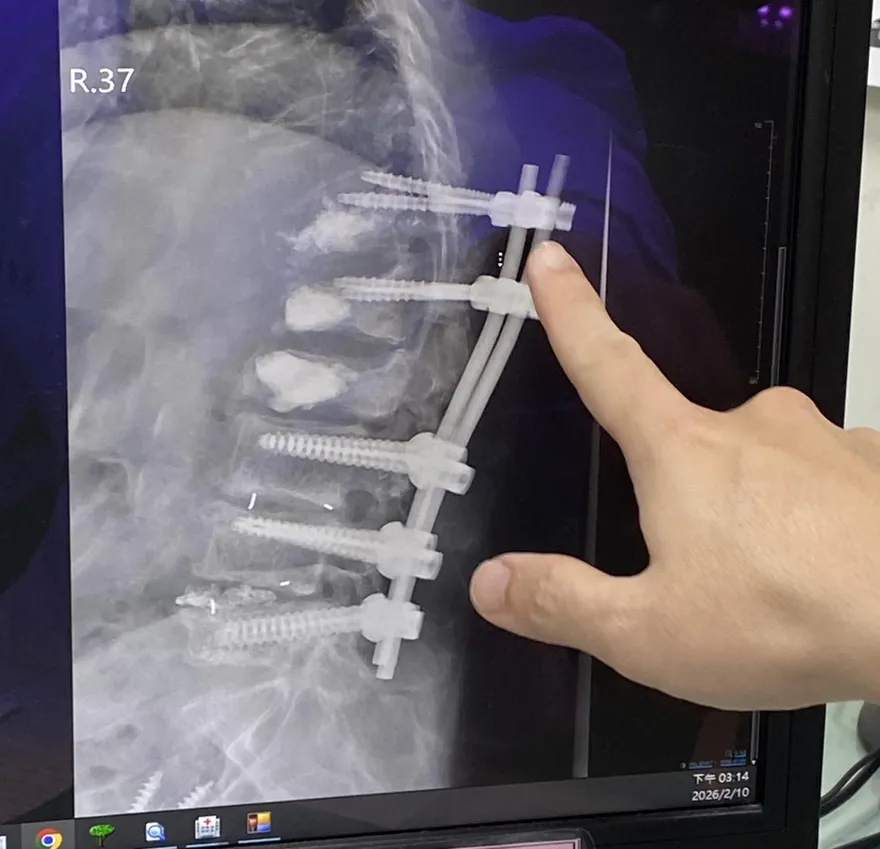 開5刀「灌骨水泥」還是痛！68歲婦靠中醫針灸重新走路