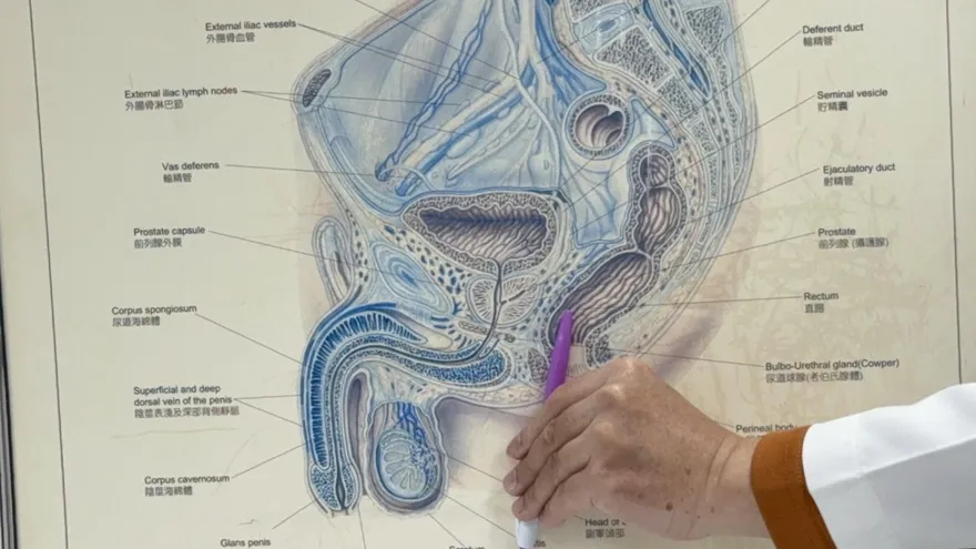 驚人！9成攝護腺癌患者檢出微塑膠　腫瘤部位濃度飆2.5倍