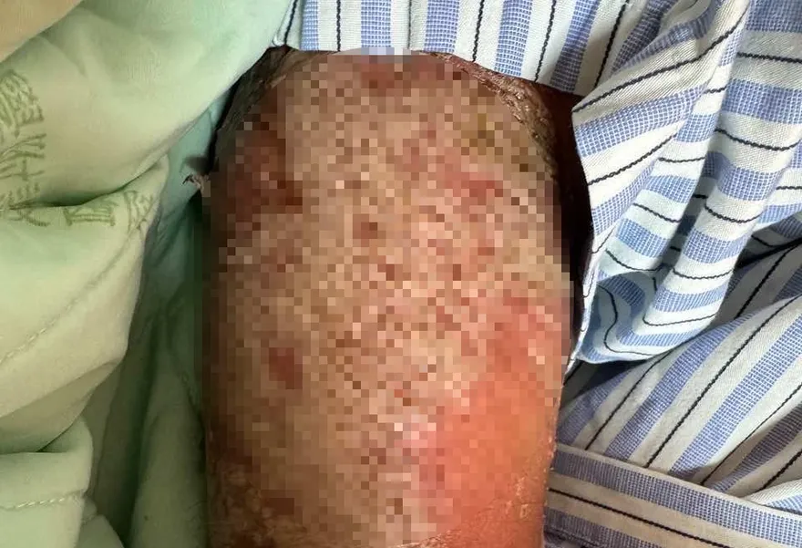 24歲男染新冠竟引發全身膿疱！罕見基因突變「1藥物」治癒