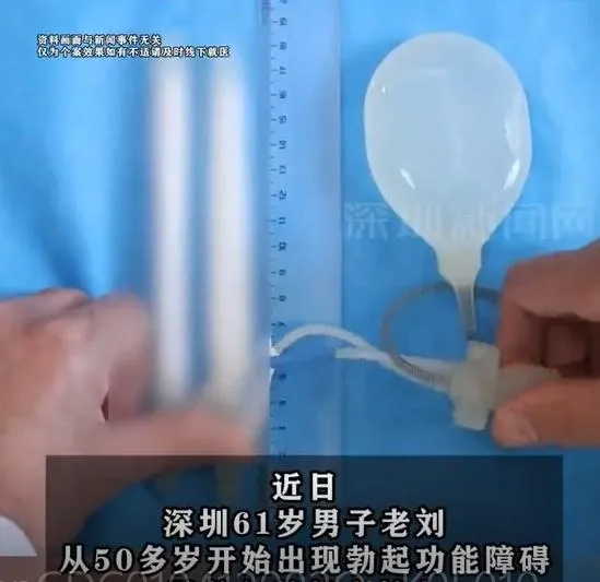 陸6旬男10年不舉！植入18cm「假體三件套」重振雄風