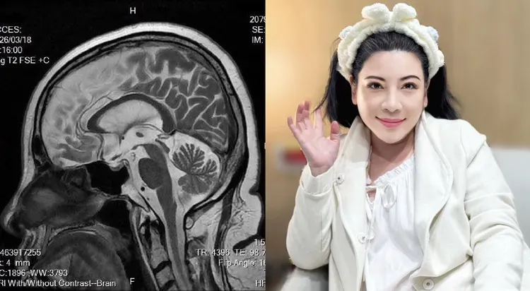 陳文茜秀「腦部MRI影像」曝病況　嘆：去年此時癌細胞激增！
