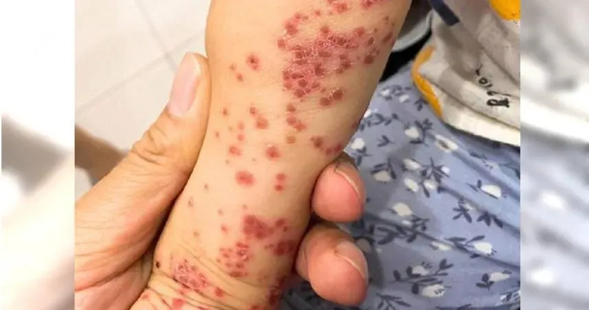 腸病毒大軍攻台！疫苗有哪些？1圖速懂差異　10招有效預防感染