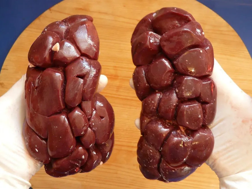柯文哲疑「急性腎損傷」持續血尿、嘔吐！醫：嚴重恐昏迷