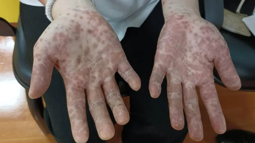 開學群聚迎「腸病毒」威脅！A71型重症率最高　醫籲施打疫苗