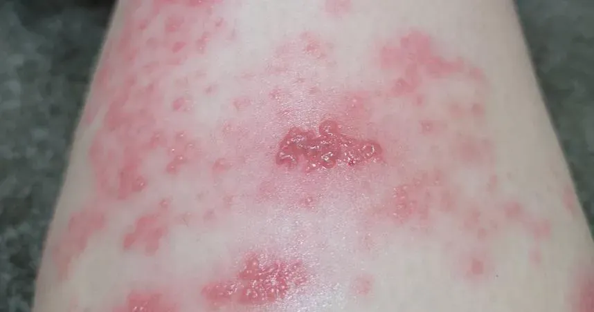 好發季來襲！醫提醒：水痘和麻疹疫苗分開打要隔28天