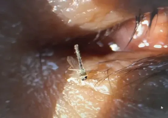 眼腫劇痛！3天後夾出2隻「搖擺蚊」　醫驚：翅膀還在動