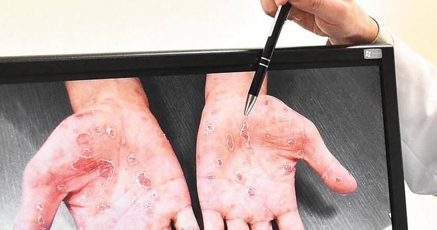 24歲以下免費梅毒快篩！疾管署推匿名諮詢、快篩服務
