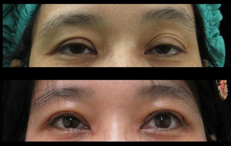47歲女困擾10年眼瞼下垂　「提眼矯正術」變身美魔女