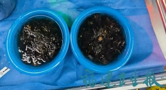 胃痛3年竟是它惹禍！陸10歲女童胃中驚取「兩大盆頭髮」