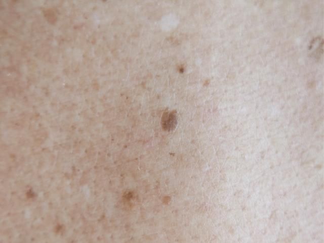 60歲男胸背長出老人斑　醫一看急叫：是胃癌！